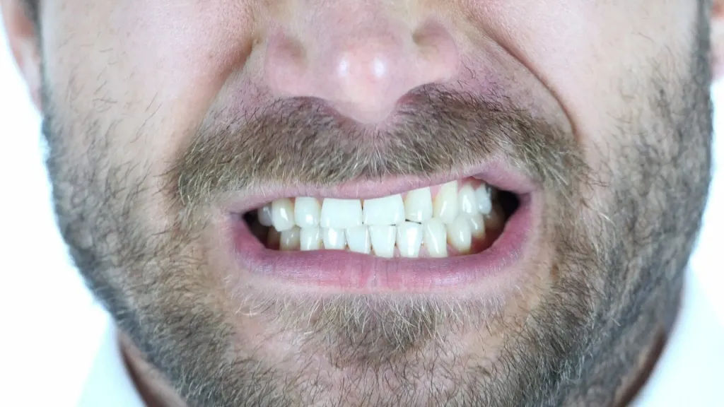 Bruxismo: Como Controlar o Ranger dos Dentes e Proteger Seu Sorriso